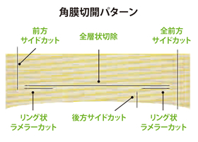 角膜切開パターン