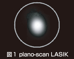 図1　plano-scan LASIK