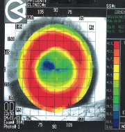 装用後の角膜形状解析像（トポグラフィー）