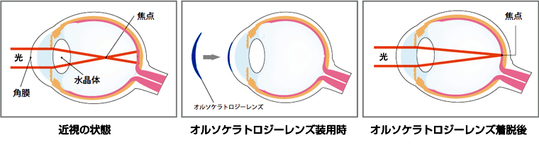 近視の状態　オルソケラトロジーレンジ装用時　オルソケラトロジーレンズ着脱後