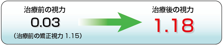 治療前の視力0.03→治療後の視力　1.18