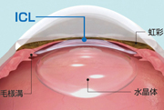 ICLレンズを毛様溝に固定します。