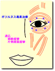 眼瞼痙攣外来 吉野眼科クリニック 最新鋭のレーシック 白内障 多焦点眼内レンズ 老眼 手術は 東京上野の眼科 レーシックセンター